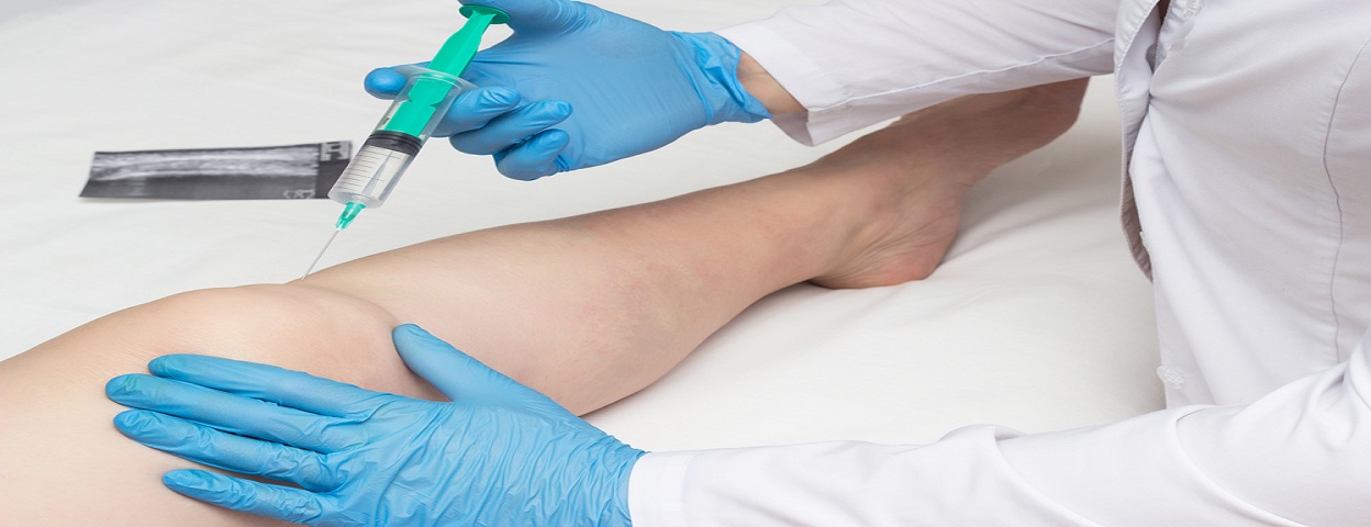 Плазмолифтинг колена отзывы. Плазмотерапия RPR. PRP плазмолифтинг суставов. Плазмотерапия коленного сустава. Плазмолифтинг коленного сустава.